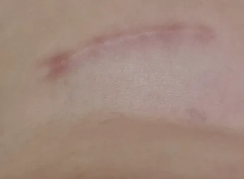 강아지 슬개골 탈구 수술 비용 및 회복 후기 — 사진 12